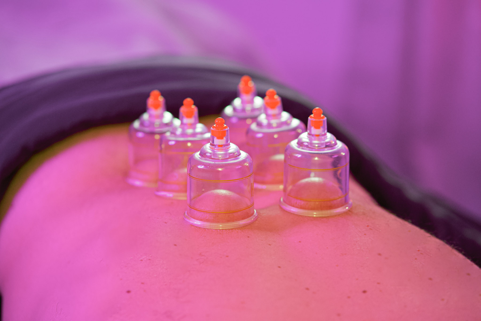 Cupping therapy treatment